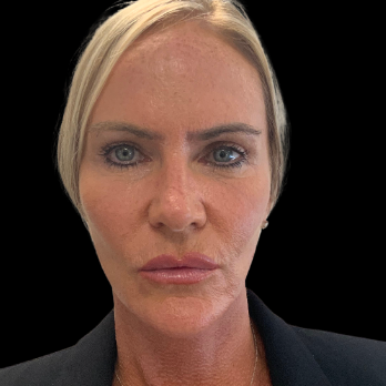 after-deep-plane-facelift-necklift-blepharoplasty